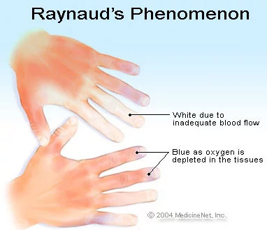 Raynaud's Phenomenon