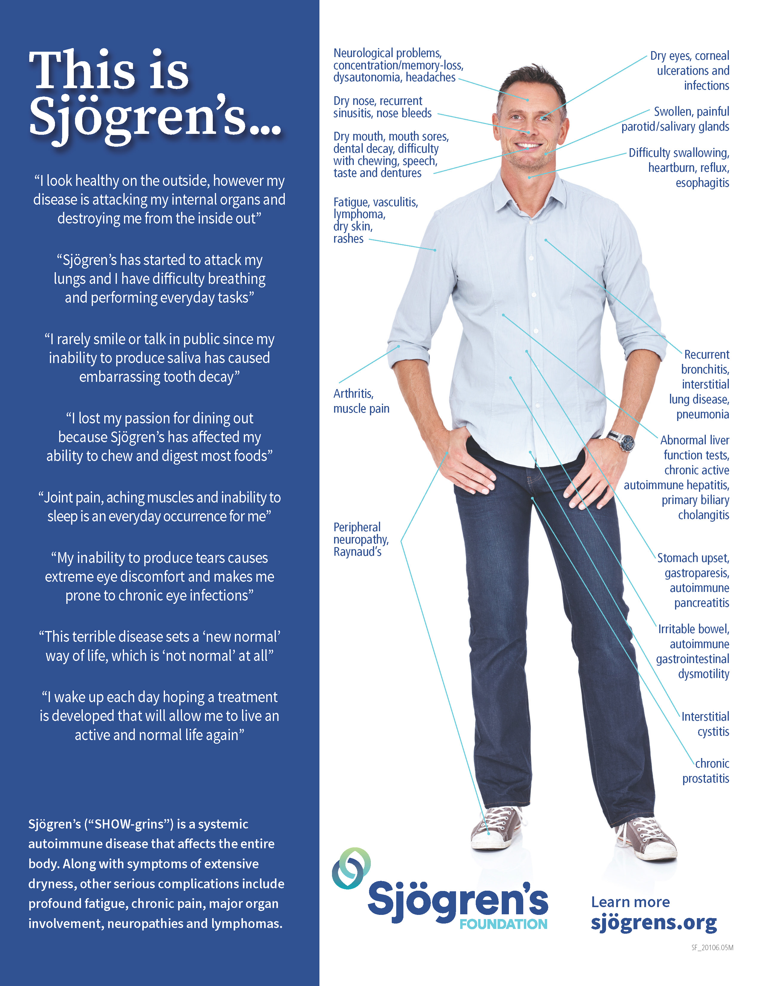 This is Sjögren's Infographic for Men